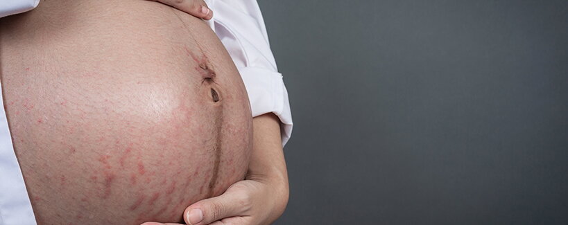 Strie po porodu: Dá se jich vůbec zbavit?